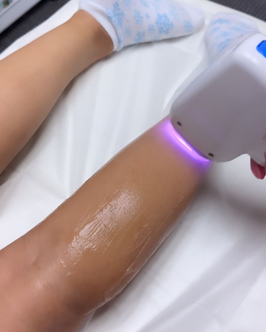 Laser hair removal treatment on a client's leg